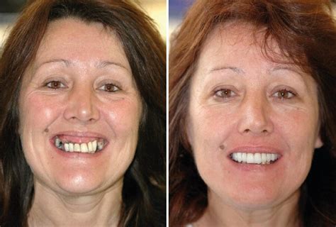 full-mouth implant in ashford|Contact – Smile In A Day .
